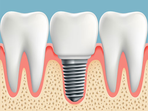 Dental Implants in %91digicity%93