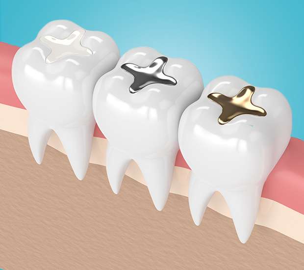 Palatine Composite Fillings