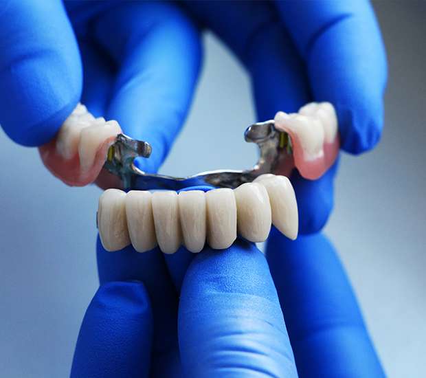 Palatine Dental Bridges