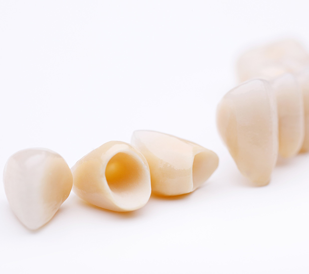 Palatine Dental Crowns and Dental Bridges