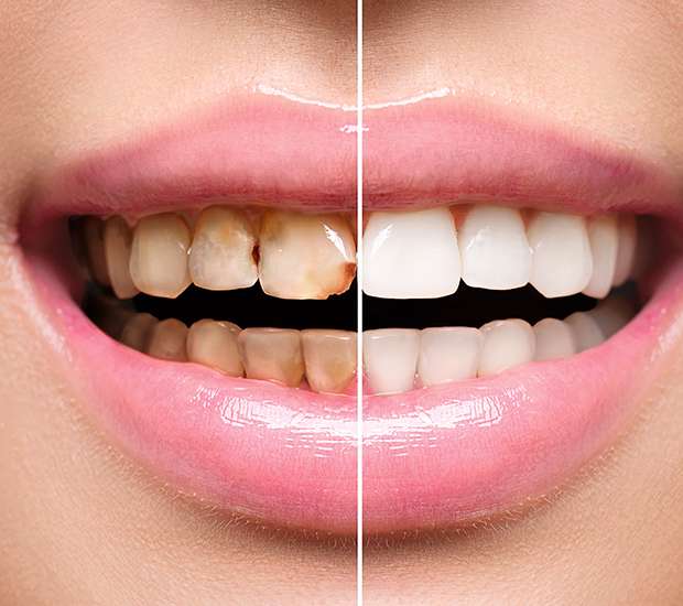Palatine Dental Implant Restoration