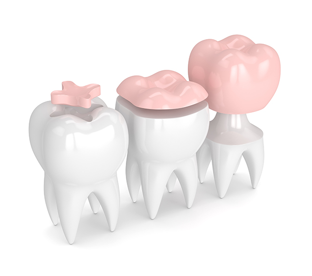 Palatine Dental Inlays and Onlays