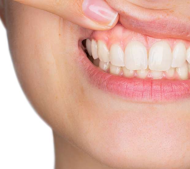 Palatine Gum Disease