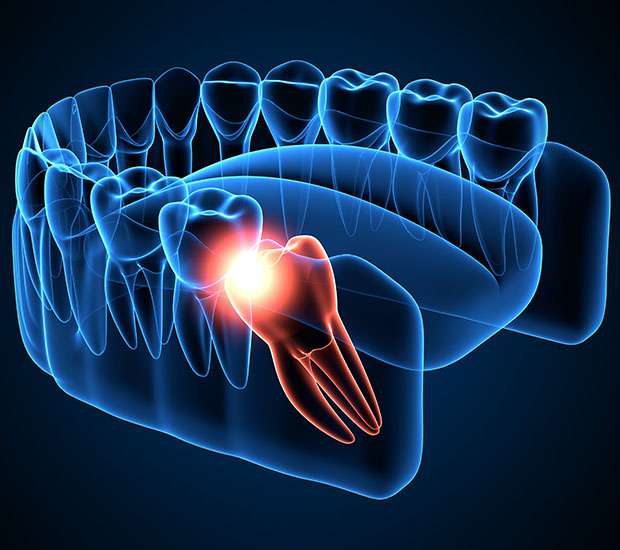 Palatine Wisdom Teeth Extraction